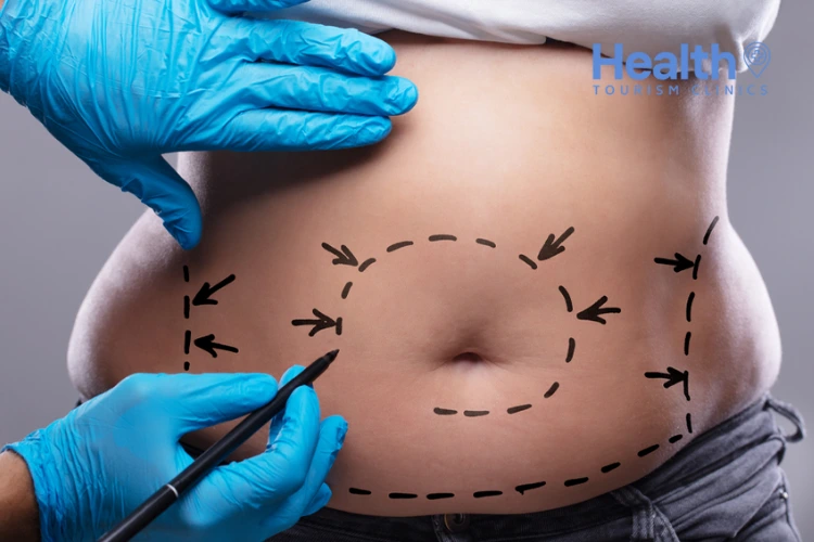 Postoperative Care After a Tummy Tuck Surgery