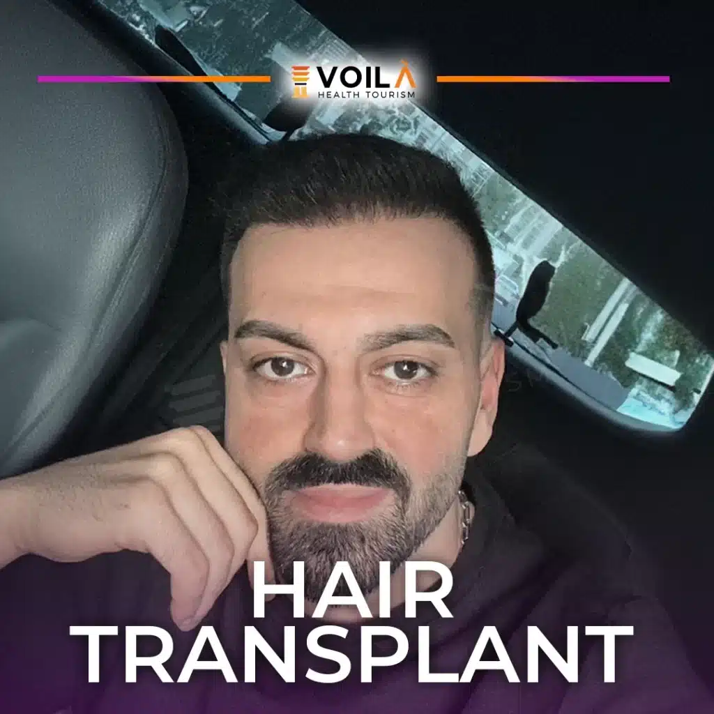 Hair Transplant