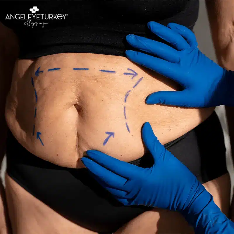 angel eye tummy tuck