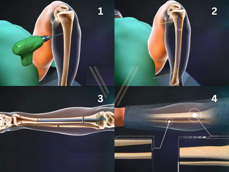 limb-lengthening-in-turkey-surgery