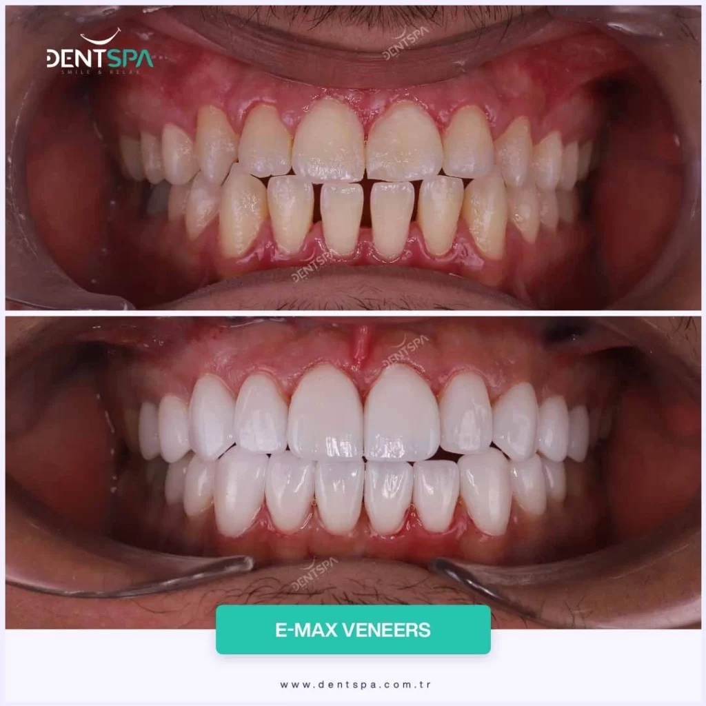 DentSpa E-Max Veneers Before After