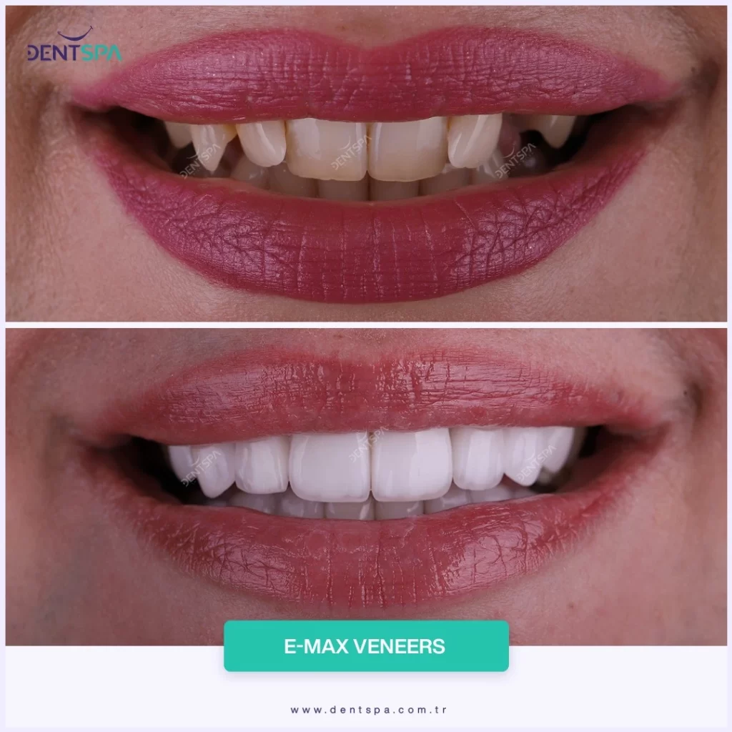 DentSpa E-Max Veneers